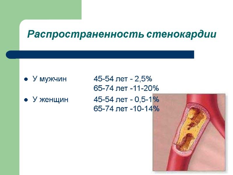 Распространенность стенокардии У мужчин   45-54 лет - 2,5%    65-74